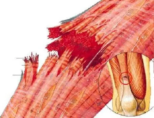 qué es la Fibrosis muscular